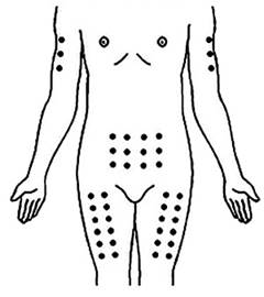 Инструкция по применению Метортрит, 10 мг/мл, раствор для инъекций, 1 мл, 1 шт. - схема 1