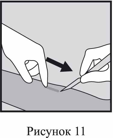 Инструкция по применению Импланон НКСТ, 68 мг, 1 шт. - схема 11