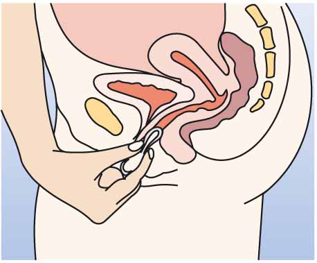 Инструкция по применению НоваРинг, 15 мкг+120 мкг/24 ч, кольца вагинальные, 1 шт. - схема 4