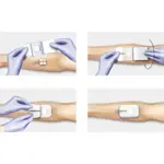 Cosmopor I.V. Повязка для фиксации катетера, 6 см х 8 см, повязка стерильная, 50 шт. фото 3