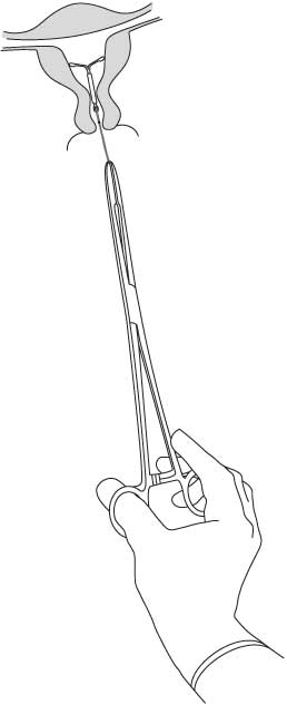 Инструкция по применению Мирена, 20 мкг/24 ч, внутриматочная терапевтическая система, 1 шт. - схема 8