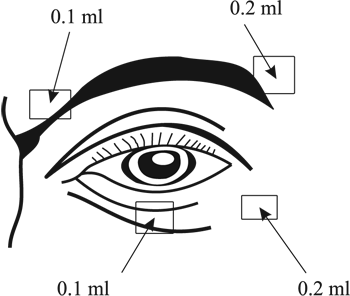 Инструкция по применению Диспорт, 300 ЕД, лиофилизат для приготовления раствора для инъекций, 3 мл, 1 шт. - схема 1