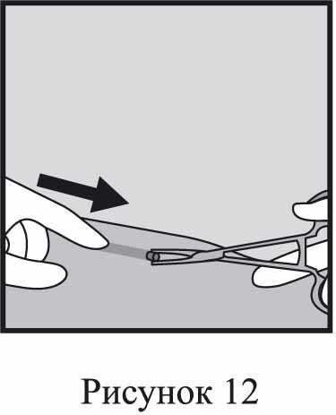 Инструкция по применению Импланон НКСТ, 68 мг, 1 шт. - схема 12