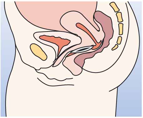 Инструкция по применению НоваРинг, 15 мкг+120 мкг/24 ч, кольца вагинальные, 1 шт. - схема 6