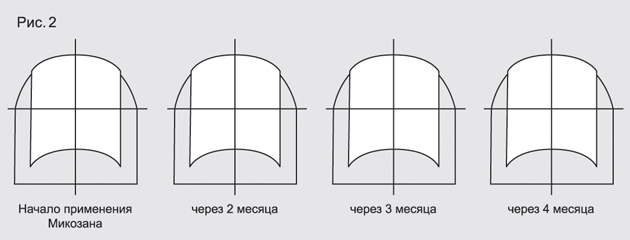 Инструкция по применению Микозан набор, жидкость для местного применения, в комплекте с пилочками, 1 шт. - схема 2