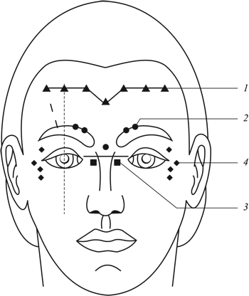 Инструкция по применению Диспорт, 300 ЕД, лиофилизат для приготовления раствора для инъекций, 3 мл, 1 шт. - схема 2