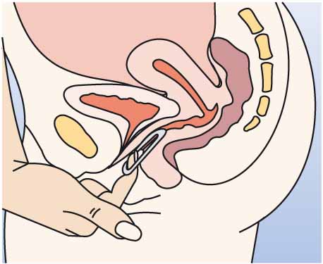 Инструкция по применению НоваРинг, 15 мкг+120 мкг/24 ч, кольца вагинальные, 1 шт. - схема 7