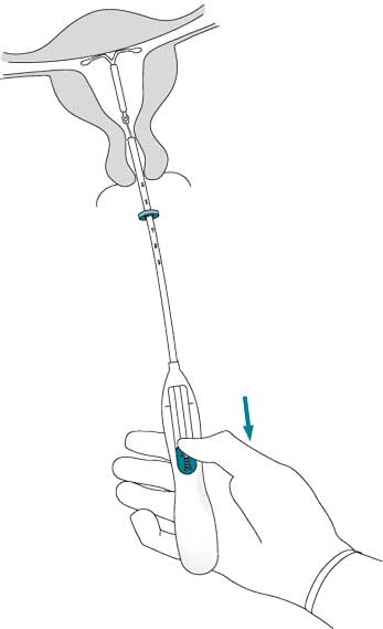 Инструкция по применению Мирена, 20 мкг/24 ч, внутриматочная терапевтическая система, 1 шт. - схема 7