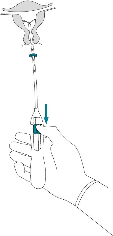 Инструкция по применению Мирена, 20 мкг/24 ч, внутриматочная терапевтическая система, 1 шт. - схема 5